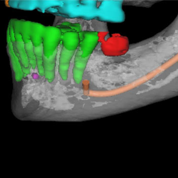 CBCT image for dental implant treatment planning